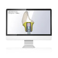 Dental Direkt Designer Abutment Creator